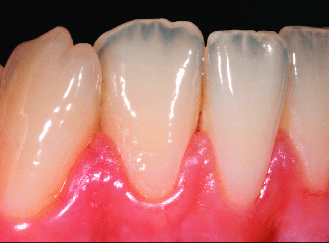 Augmentation-de-la-translucidite-du-collet-vers-le-bord-libre-de-ces-dents-jeunes-Les