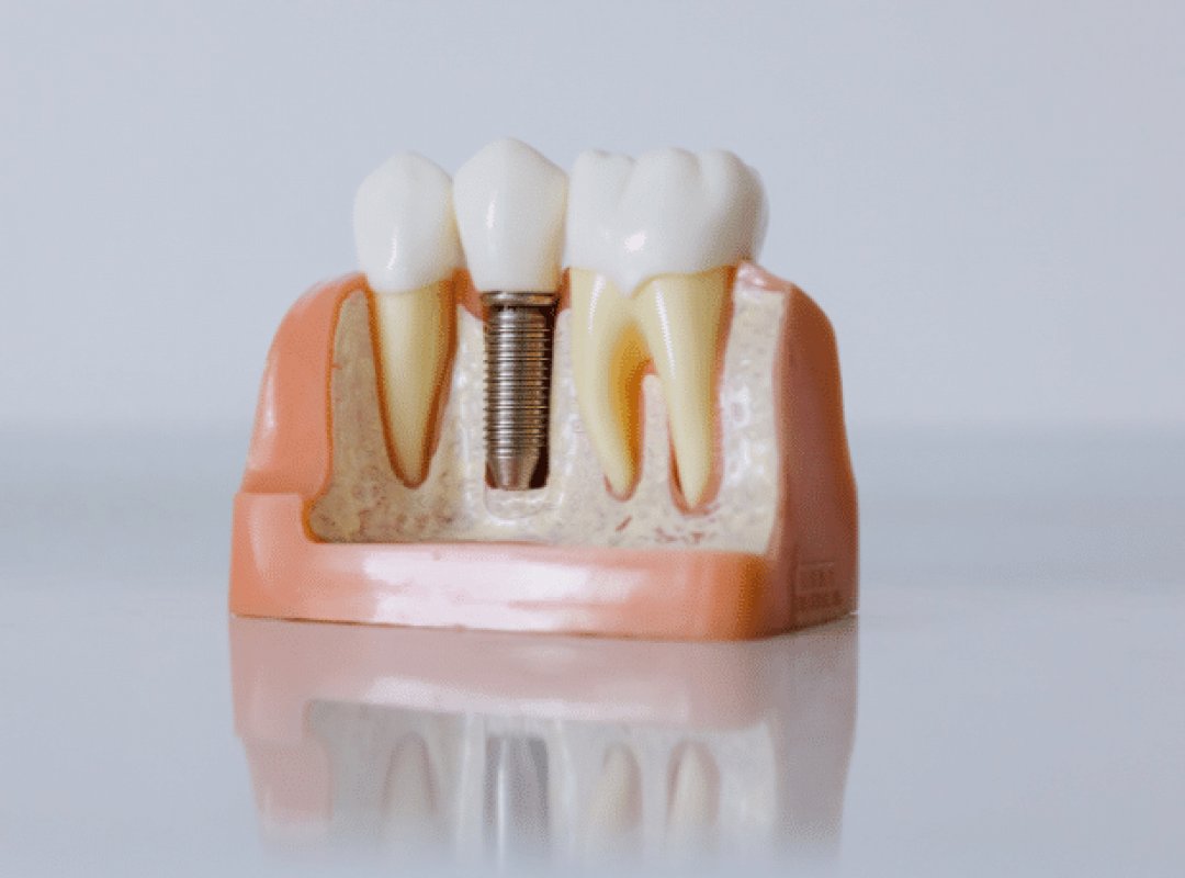 implants-dentaires-paris